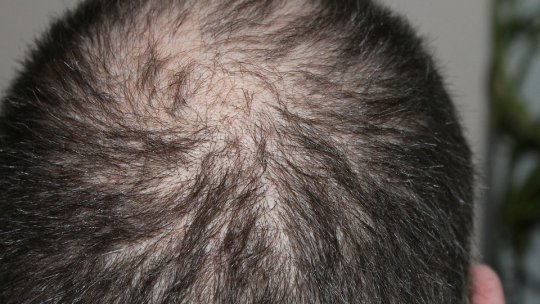 Demersuri pentru deschiderea unui centru pentru transplant de păr, la Brașov