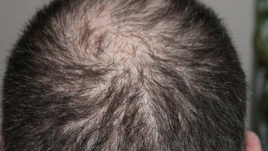 Brașovenii nu mai trebuie să se deplaseze în Turcia pentru un transplant de păr