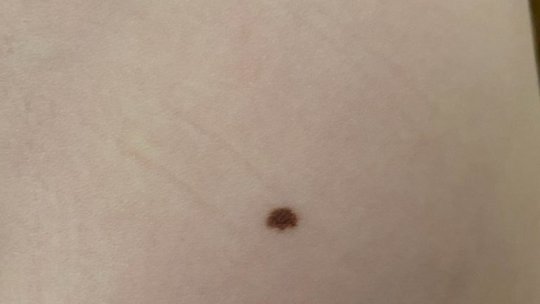 Cei mai mulți români au informații despre cancerul de piele, dar nu merg la dermatolog